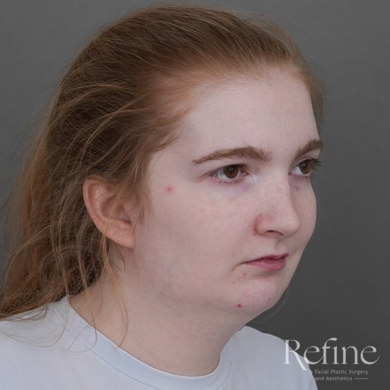 Chin Augmentation Before & After Gallery - Patient 142922 - Image 1