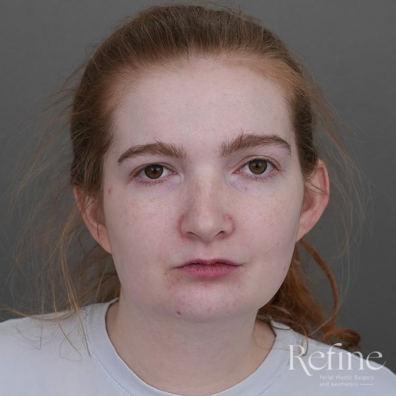 Chin Augmentation Before & After Gallery - Patient 142922 - Image 5