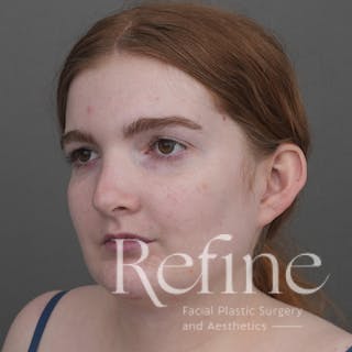 Chin Augmentation Before & After Gallery - Patient 142922 - Image 8