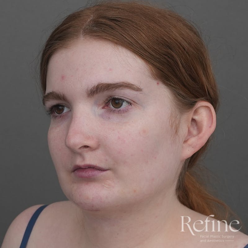 Chin Augmentation Before & After Gallery - Patient 142922 - Image 8