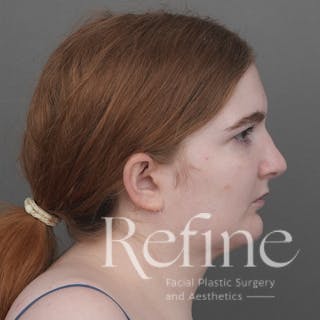 Chin Augmentation Before & After Gallery - Patient 142922 - Image 4