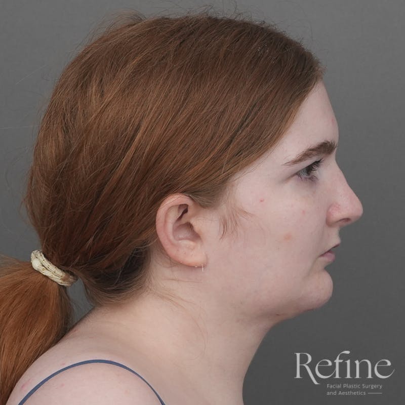 Chin Augmentation Before & After Gallery - Patient 142922 - Image 4