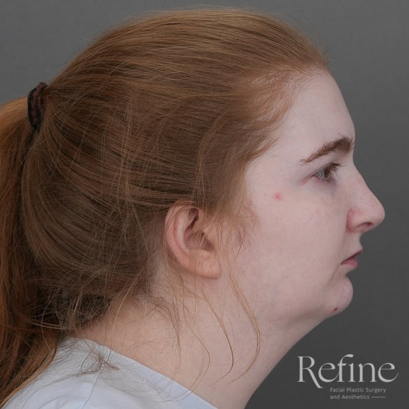 Chin Augmentation Before & After Gallery - Patient 142922 - Image 3