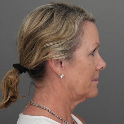 Deep Plane Facelift Before & After Gallery - Patient 293097 - Image 1