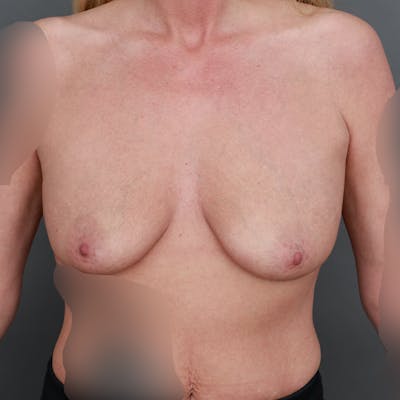 Breast Augmentation with Lift Before & After Gallery - Patient 282841 - Image 1