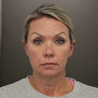 Brow Lift Before & After Gallery - Patient 405739 - Image 1