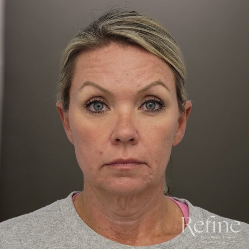 Neck Liposuction Before & After Gallery - Patient 844290 - Image 5