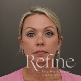 Neck Liposuction Before & After Gallery - Patient 844290 - Image 6