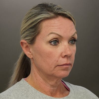 Neck Liposuction Before & After Gallery - Patient 844290 - Image 1