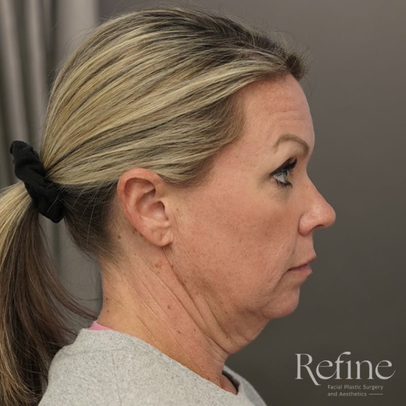 Neck Liposuction Before & After Gallery - Patient 844290 - Image 3