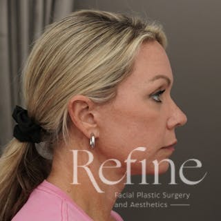 Neck Liposuction Before & After Gallery - Patient 844290 - Image 4