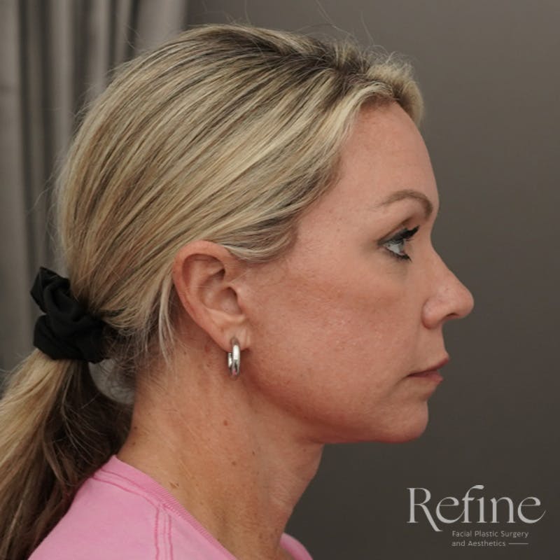 Neck Liposuction Before & After Gallery - Patient 844290 - Image 4