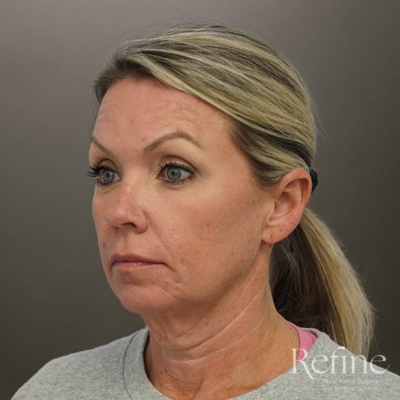 Neck Liposuction Before & After Gallery - Patient 844290 - Image 7