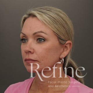 Neck Liposuction Before & After Gallery - Patient 844290 - Image 8