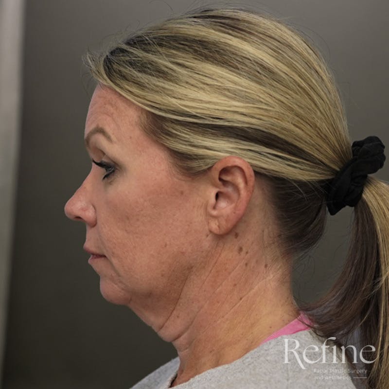 Neck Liposuction Before & After Gallery - Patient 844290 - Image 9
