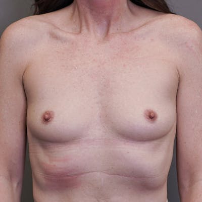 Breast Augmentation Before & After Gallery - Patient 106078 - Image 1