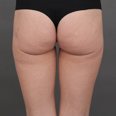 Brazilian Butt Lift (BBL) Before & After Gallery - Patient 288887 - Image 1