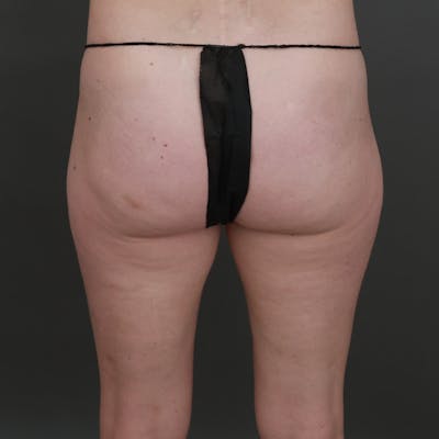 Brazilian Butt Lift (BBL) Before & After Gallery - Patient 145176 - Image 1