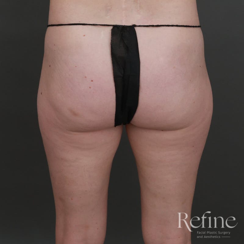 Brazilian Butt Lift (BBL) Before & After Gallery - Patient 145176 - Image 1