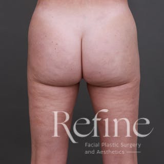 Brazilian Butt Lift (BBL) Before & After Gallery - Patient 145176 - Image 2