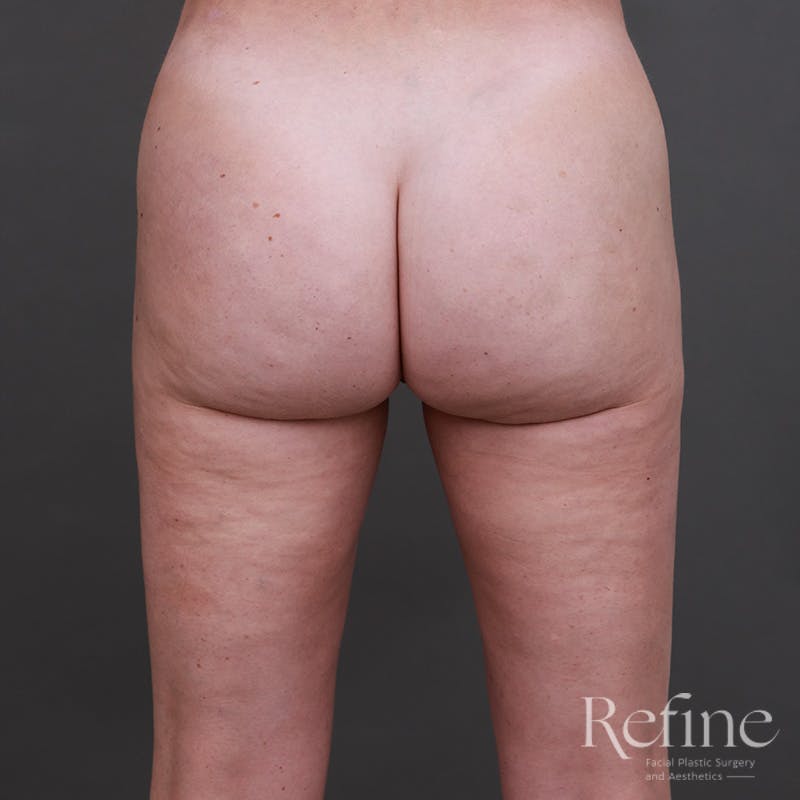 Brazilian Butt Lift (BBL) Before & After Gallery - Patient 145176 - Image 2