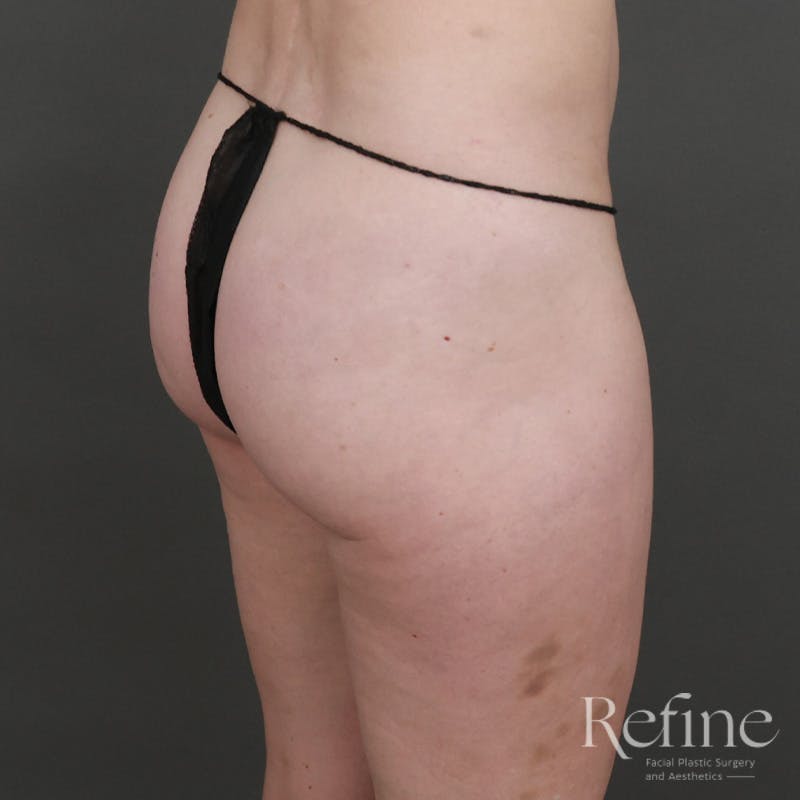 Brazilian Butt Lift (BBL) Before & After Gallery - Patient 145176 - Image 3
