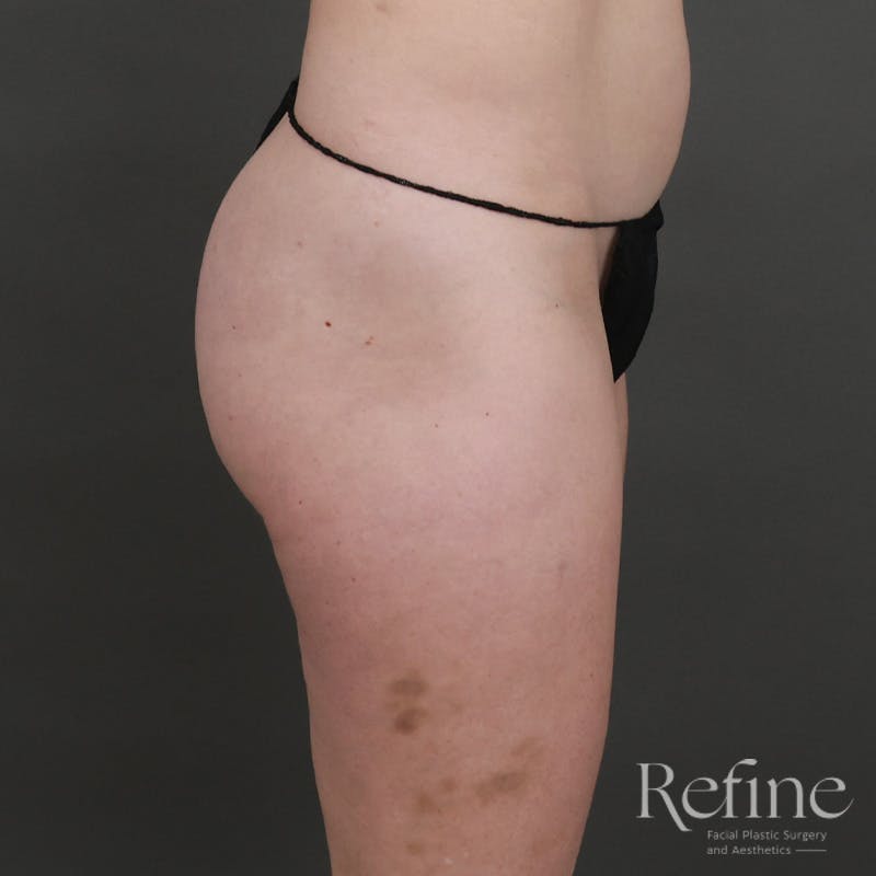 Brazilian Butt Lift (BBL) Before & After Gallery - Patient 145176 - Image 5
