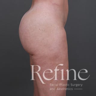 Brazilian Butt Lift (BBL) Before & After Gallery - Patient 145176 - Image 6