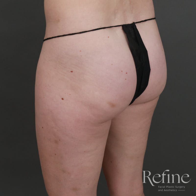 Brazilian Butt Lift (BBL) Before & After Gallery - Patient 145176 - Image 7