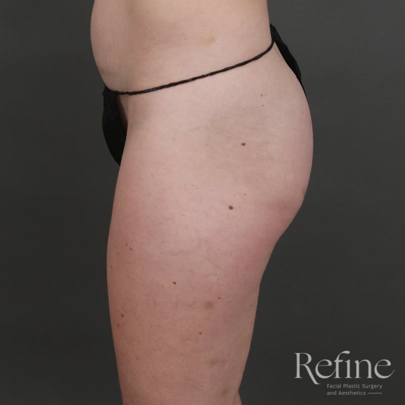 Brazilian Butt Lift (BBL) Before & After Gallery - Patient 145176 - Image 9