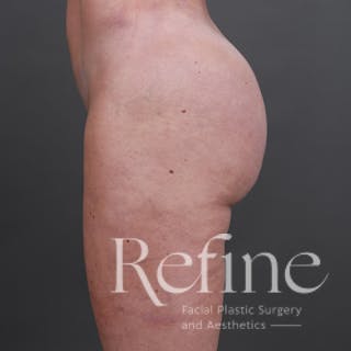 Brazilian Butt Lift (BBL) Before & After Gallery - Patient 145176 - Image 10