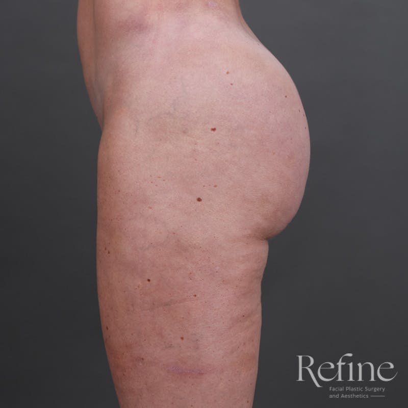 Brazilian Butt Lift (BBL) Before & After Gallery - Patient 145176 - Image 10