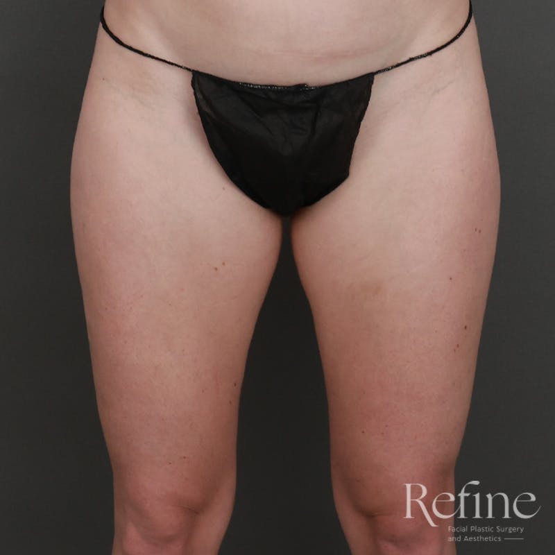 Brazilian Butt Lift (BBL) Before & After Gallery - Patient 145176 - Image 11