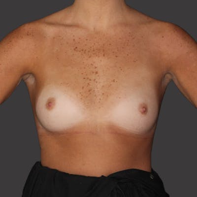 Breast Augmentation Before & After Gallery - Patient 271846 - Image 1