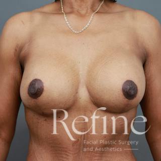 Breast Augmentation with Lift Before & After Gallery - Patient 312642 - Image 2