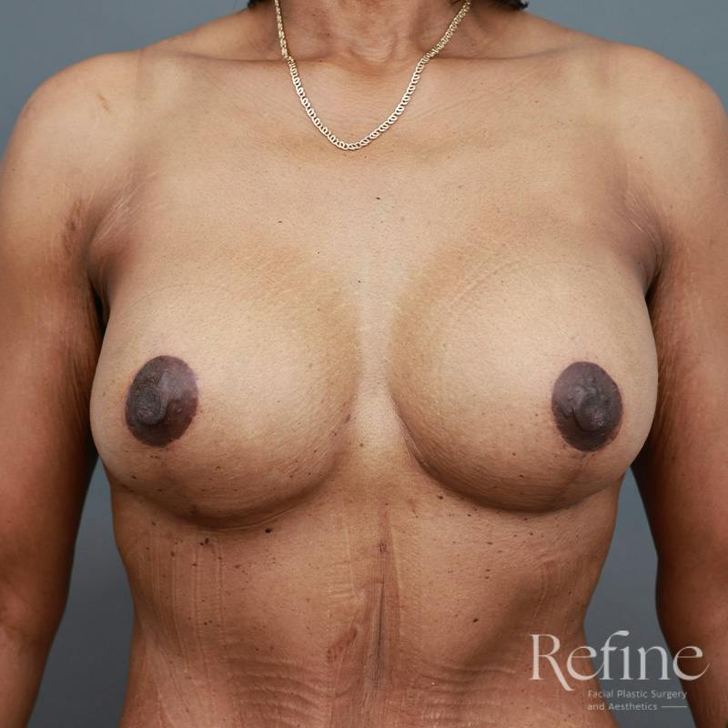 Breast Augmentation with Lift Before & After Gallery - Patient 312642 - Image 2