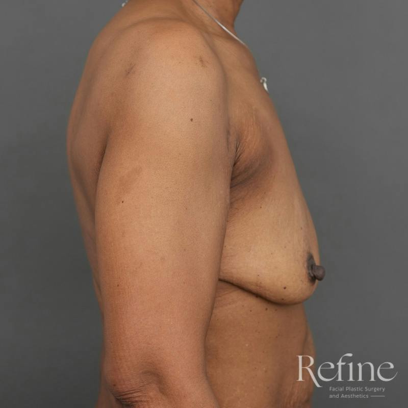Breast Augmentation with Lift Before & After Gallery - Patient 312642 - Image 5