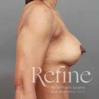 Breast Augmentation with Lift Before & After Gallery - Patient 312642 - Image 6