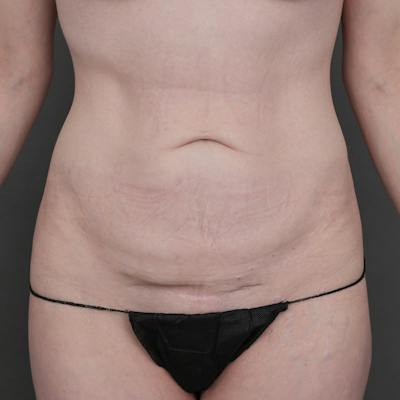 Tummy Tuck Before & After Gallery - Patient 234953 - Image 1