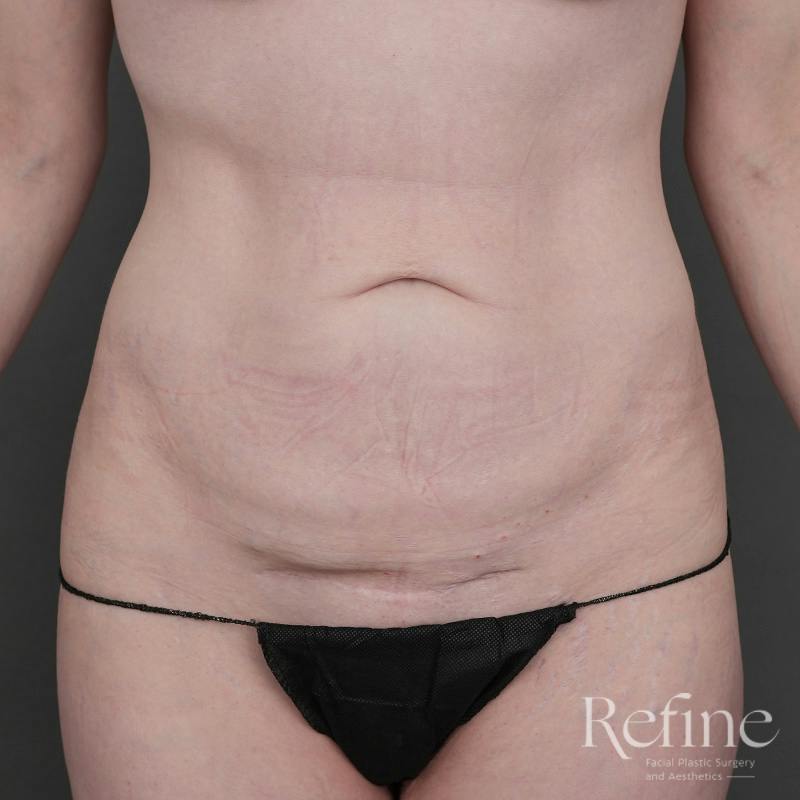 Tummy Tuck Before & After Gallery - Patient 234953 - Image 1