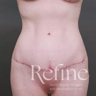Tummy Tuck Before & After Gallery - Patient 234953 - Image 2