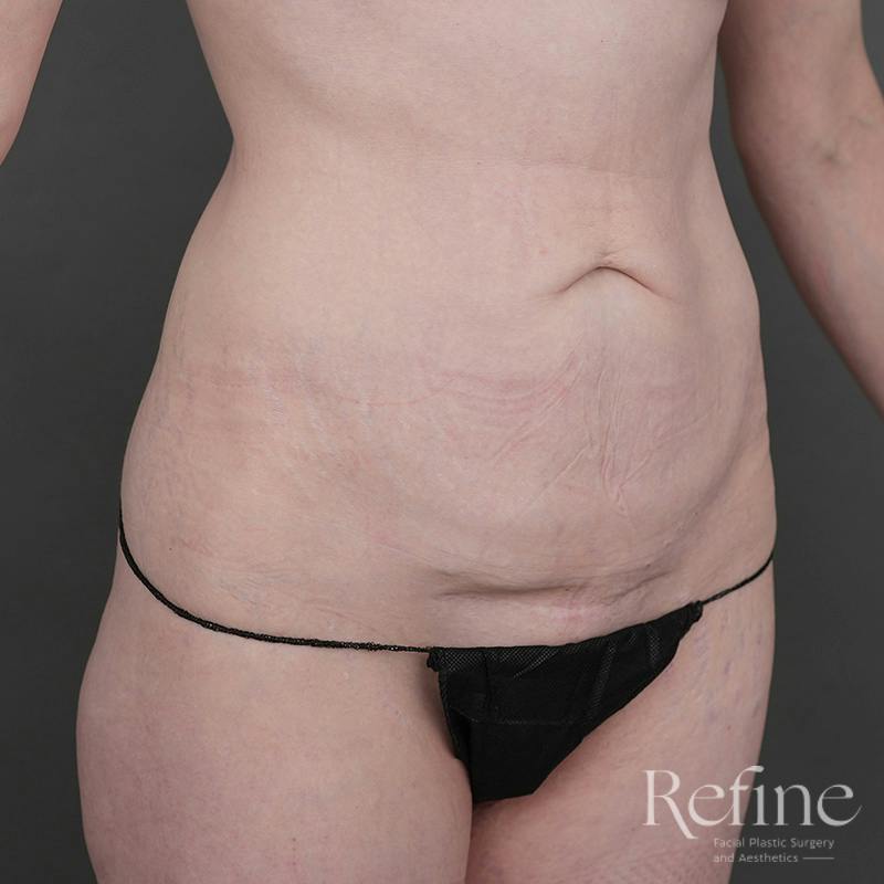 Tummy Tuck Before & After Gallery - Patient 234953 - Image 3