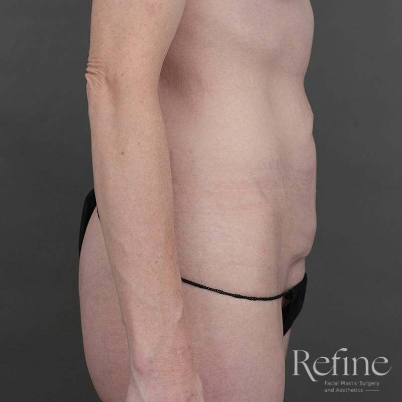 Tummy Tuck Before & After Gallery - Patient 234953 - Image 5