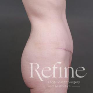 Tummy Tuck Before & After Gallery - Patient 234953 - Image 6