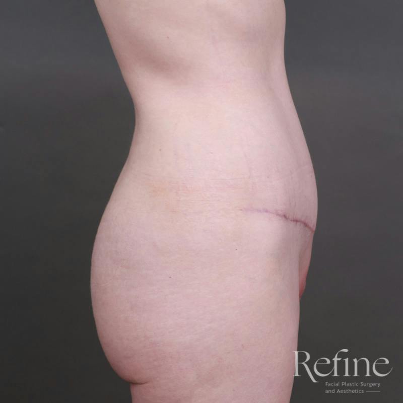Tummy Tuck Before & After Gallery - Patient 234953 - Image 6