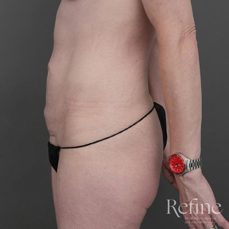 Tummy Tuck Before & After Gallery - Patient 234953 - Image 9