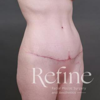 Tummy Tuck Before & After Gallery - Patient 234953 - Image 4
