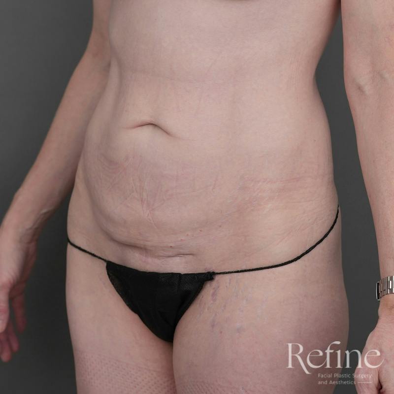 Tummy Tuck Before & After Gallery - Patient 234953 - Image 7