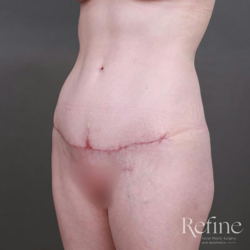 Tummy Tuck Before & After Gallery - Patient 234953 - Image 8