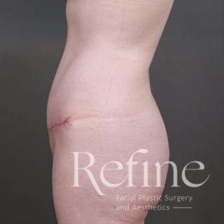 Tummy Tuck Before & After Gallery - Patient 234953 - Image 10